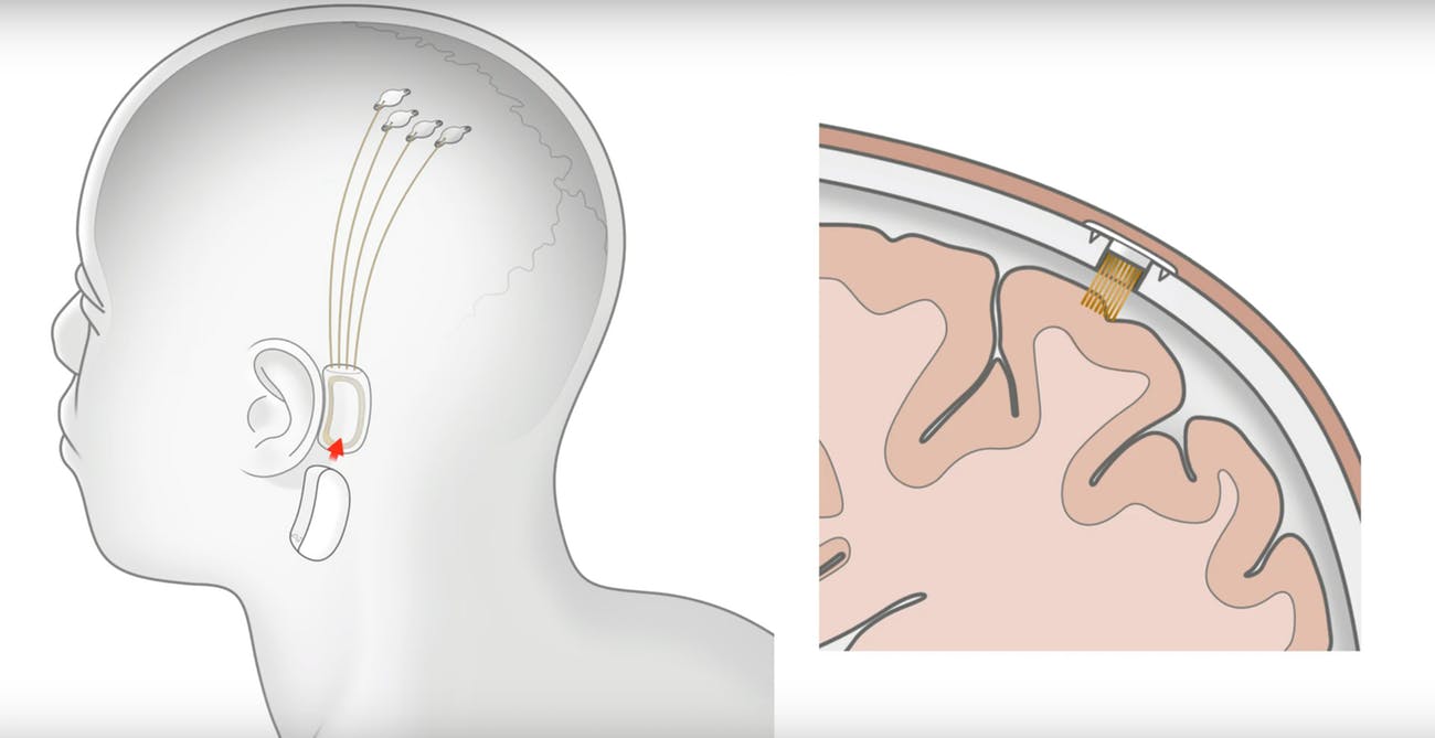 Neuralink N1 implant at the ear (credit: Inverse)